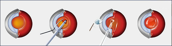 Cataract Surgery Diagram