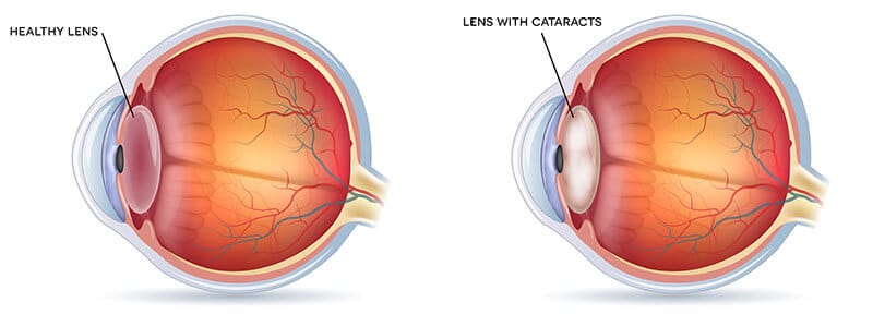 Chart Illustrating a Healthy Eye Compared to One With a Cataract