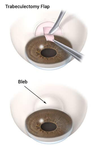 Chart Illustrating the Filtration Surgery Process